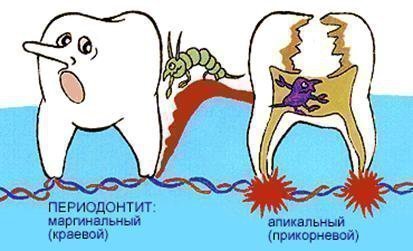 Причини і симптоми періодонтиту у дітей