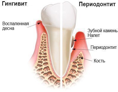 Причини і симптоми періодонтиту у дітей