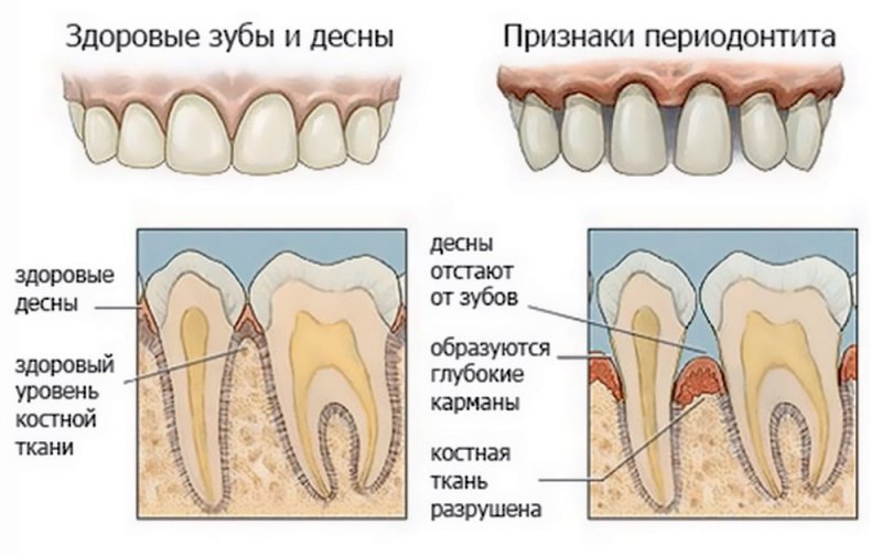 Причини і симптоми періодонтиту у дітей