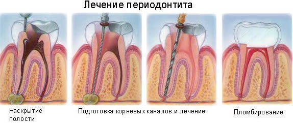 Причини і симптоми періодонтиту у дітей