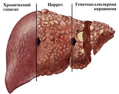 Чому не можна пити алкогольні напої після анестезії зуба