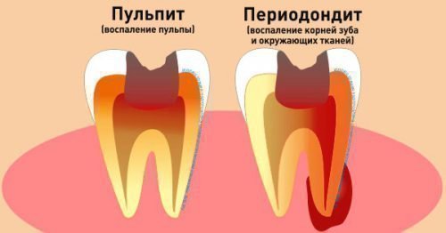 Причини запалення кореня зуба