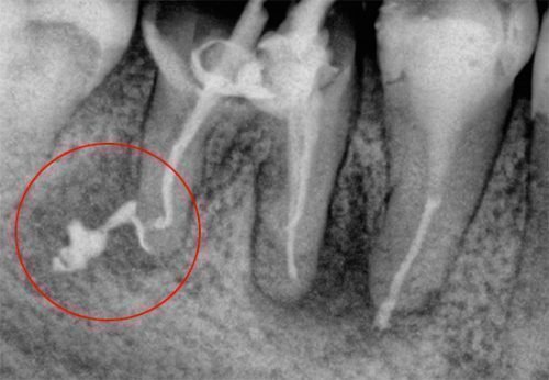 Причини запалення кореня зуба