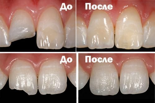 Причини перелому зуба