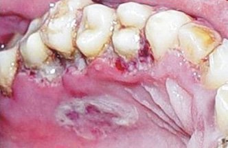 Етіологія виразково-некротичного гінгівіту і його лікування