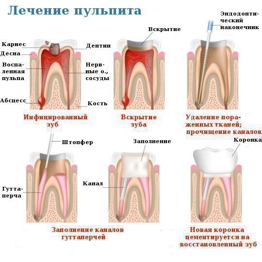 Різниця між пульпітом і періодонтитом