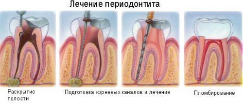 Різниця між пульпітом і періодонтитом