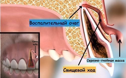 Лікування свища під час вагітності і не тільки