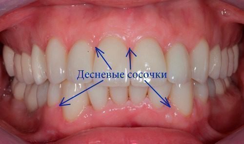 Міжзубні сосочки і проблеми з ними