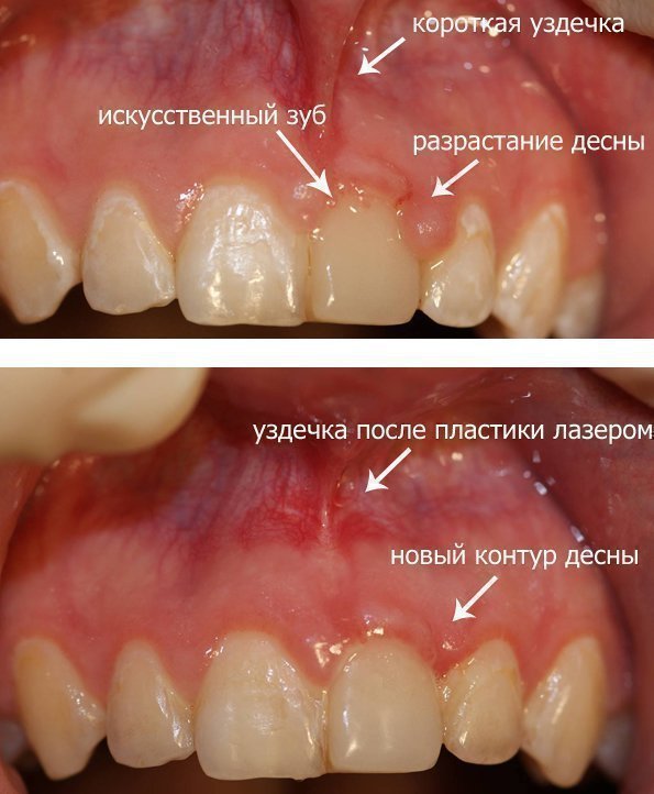 Міжзубні сосочки і проблеми з ними