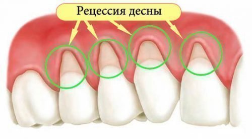 Принцип лікування пародонтозу