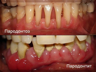 Застосування народної медицини в лікуванні пародонтозу