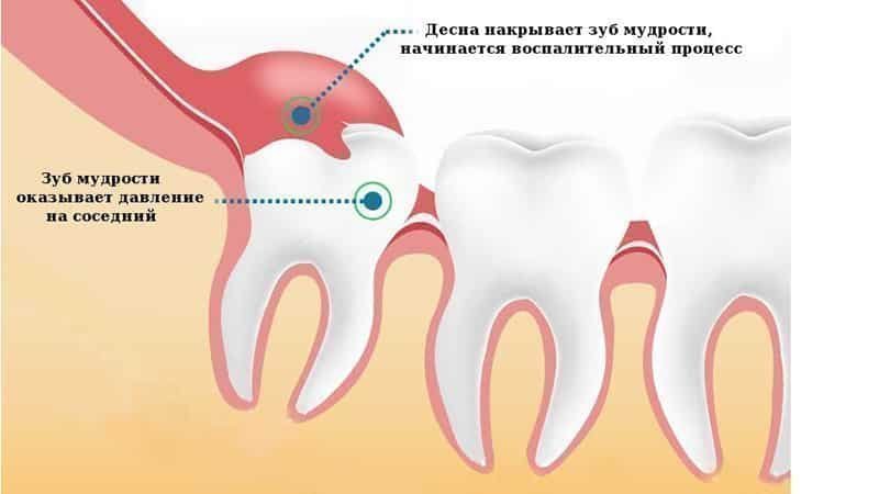 Причини появи капюшона на зубі мудрості